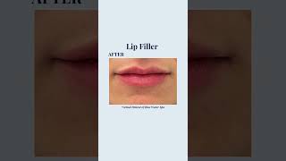 Lip Filler Injections  Before and After Lip Augmentation [upl. by Sibell]