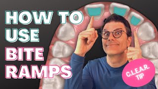 How and when to use Invisalign clear aligners bite ramps [upl. by Forsta]