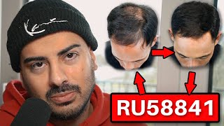 RU58841 ist besser als Finasterid und Minoxidil zusammen  Geheimtipp gegen Haarausfall [upl. by Dolli822]