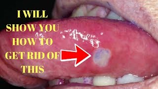 What Are Canker Sores Causes and 8 Useful Treatments [upl. by Aligna]