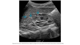 Angiomyolipoma Imaging [upl. by Ulund131]