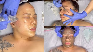 MICRONEEDLING FACIAL WITH DERMAPLANE  MY FIRST MICRONEEDLING TREATMENT  PREPARATION AND AFTERCARE [upl. by Kahler]