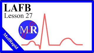 Left Anterior Fascicular Block LAFB [upl. by Puett]