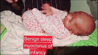 Benign sleep myoclonus  neonatal seizures  Signs symptoms and diagnosis  newborn fits  jhatky [upl. by Eizzo]