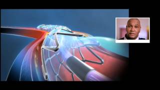 What is a stent and how does it work [upl. by Ruy517]