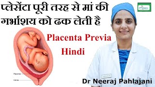 Placenta Previa होने के लक्षण इलाज और Low Lying Placenta से कैसे बचे [upl. by Balliol28]