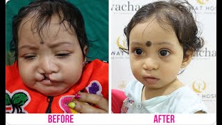 कटे होंठ कटे तालु का निःशुल्क इलाज  Cleft Lip and Palate Surgery at Saraswat Hospital Agra India [upl. by Niall976]