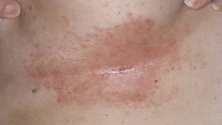 DermTV  How to Treat Under Breast Rashes amp Infections DermTVcom Epi 190 [upl. by Marleah75]