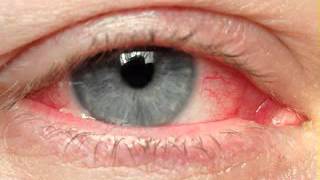 Eye cancer symptoms [upl. by Einahets679]