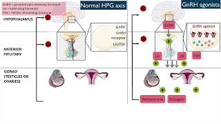 Gonadotropinreleasing hormone GnRH agonists [upl. by Phylys]