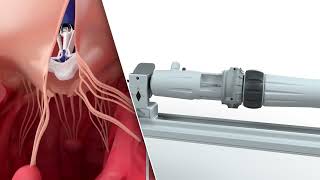 PASCAL Precision System – Implantation of the device in the mitral and tricuspid valves  Animation [upl. by Norris619]