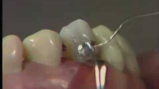 Class V Amalgam Restoration Finishing and Polishing [upl. by Neu541]