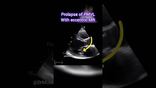 Prolapse of Posterior Mitral Valve Leaflet with Eccentric MR echocardiogram echocardiography [upl. by Haldas]