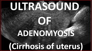 Ultrasound of Adenomyosis [upl. by Vita849]