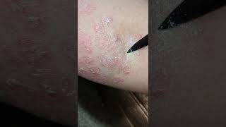 ASMR Psoriasis flake removal scraping [upl. by Nahtanod]