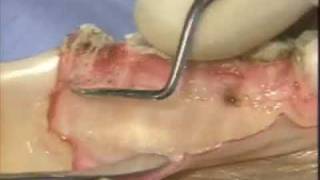 Introductory Periodontal Surgical Techniques The Apically Positioned Flap and Crown Lengthening [upl. by Cirederf746]