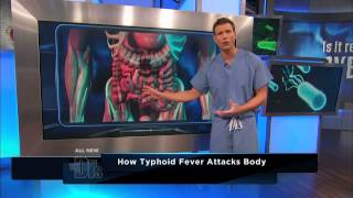 How Typhoid Fever Affects the Body  The Doctors [upl. by Yantruoc960]