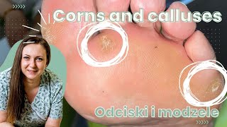 Corns and calluses  Odciski i modzele [upl. by Eniffit435]