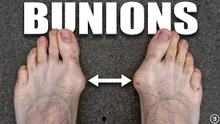 Bunions  Hallux Valgus Diagnosis Exercises Treatment [upl. by Saideman]