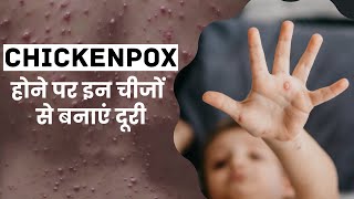 Chickenpox होने पर तुरंत करें इन चीजों से परहेज जल्‍द म‍िलेगा आराम [upl. by Yrok]