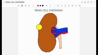 RENAL CELL CARCINOMA [upl. by Lerual]