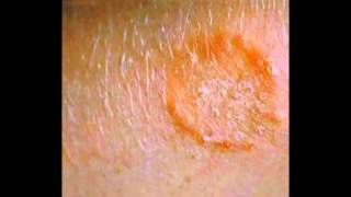 Skin Fungus Signs Symptoms Treatment HD [upl. by Stag]