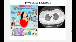 Invasive Aspergillosis [upl. by Stinky]