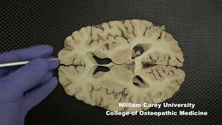 Horizontal slices of human forebrain neuroanatomy forebrain internal capsule caudate nucleus [upl. by Nawyt]