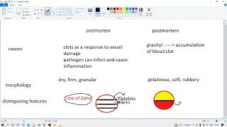 Antemortem vs postmortem clot differences [upl. by Karole807]