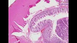 Histopathology Colon Adenocarcinoma [upl. by Oicapot819]