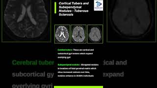 Cortical Tubers and Subependymal NodulesTuberous sclerosis [upl. by Lowndes555]