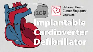 What is an Implantable CardioverterDefibrillator ICD  What to Expect [upl. by Evander]