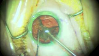 Routine Cataract Surgery  Narrated [upl. by Yllaw]