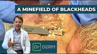 A Minefield of Blackheads  Dr Derm [upl. by Erodavlas]