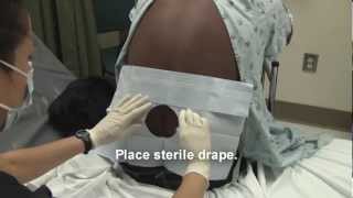 Adult Spinal Tap Procedure Video [upl. by Anallese]