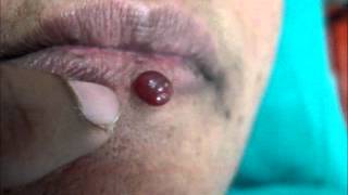 Hemangioma Lower Lip [upl. by Melgar]