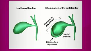 Pain Caused by Gallbladder Inflammation [upl. by Samul735]