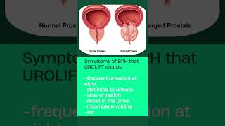 UroLift New in Health amp Technology for Prostate  Dr Himesh Gandhi [upl. by Aened769]