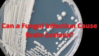 Can A Fungal Infection Cause Brain Lesions [upl. by Demona776]