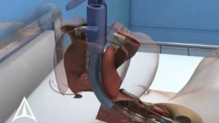 Intubix Endotracheal Tube Holder  3D Medical Device Animation [upl. by Sophy]