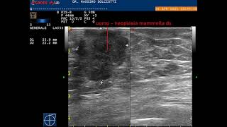 neoplasia mammaria destra nelluomo [upl. by Launam]