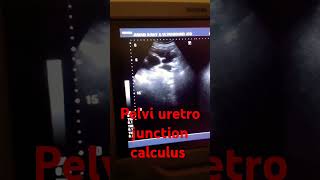 Pelvi uretro junction calculus with massive hydronephrosis massive ultrasound ultrasound calculu [upl. by Thalassa]