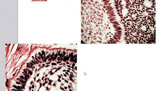 Unicystic Ameloblastoma  Odontogenic Tumor Part4  ORAL PATHOLOGY for BDSMDS STUDENTSASPIRANTS [upl. by Copp198]