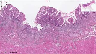 Ulcerative Colitis  Histopathology [upl. by Ingles]