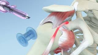 Right Shoulder Rotator Cuff Repair and Biceps Tenodesis Animation [upl. by Amberly338]