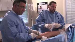 RF Procedure for treatment of varicose veins [upl. by Naujet]