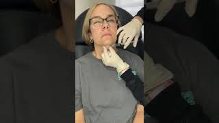 Injecting Kybella with a fanning technique kybella doublechin she had AMAZING results from just 1 [upl. by Eniamat449]