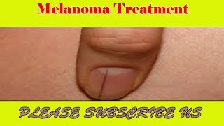 Black Line ON Nail Melanoma Treatment  Malignant Melanoma  Prevention Tips and Treatment Methods [upl. by Rawna359]