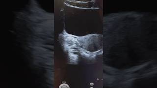 Dermoid cyst sonography  dermoid mesh ultrasound  adenexal mass  ARDMS obgyn [upl. by Anilra]