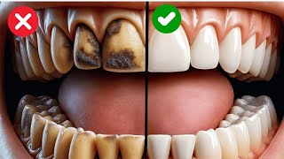 9 Natural Ways To Remove Plaque And Tartar From Your Teeth [upl. by Desi]